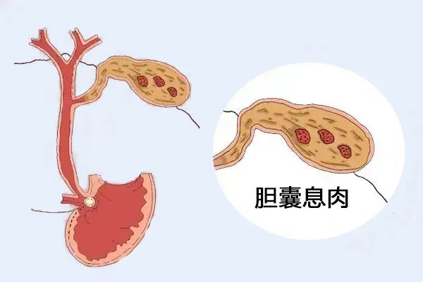 體檢出膽囊息肉，需要擔(dān)心嗎？