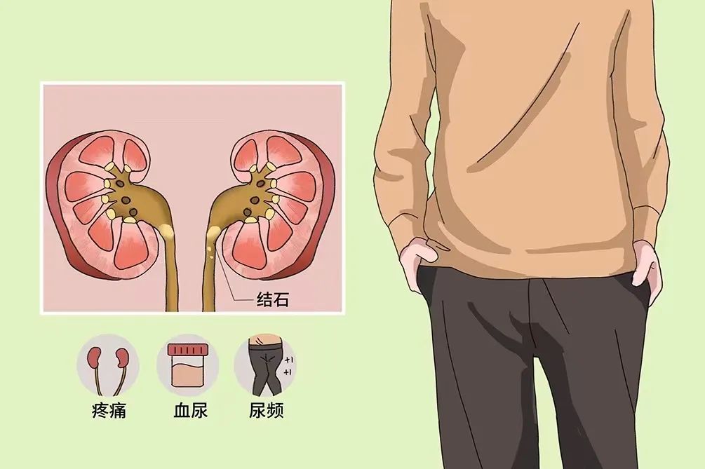 為什么很多人得腎結(jié)石？有2個習(xí)慣不要碰，腎會感激你