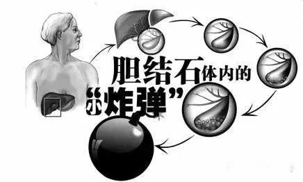 膽囊里的小結(jié)石要緊嗎？長(zhǎng)大后再處理行不行？